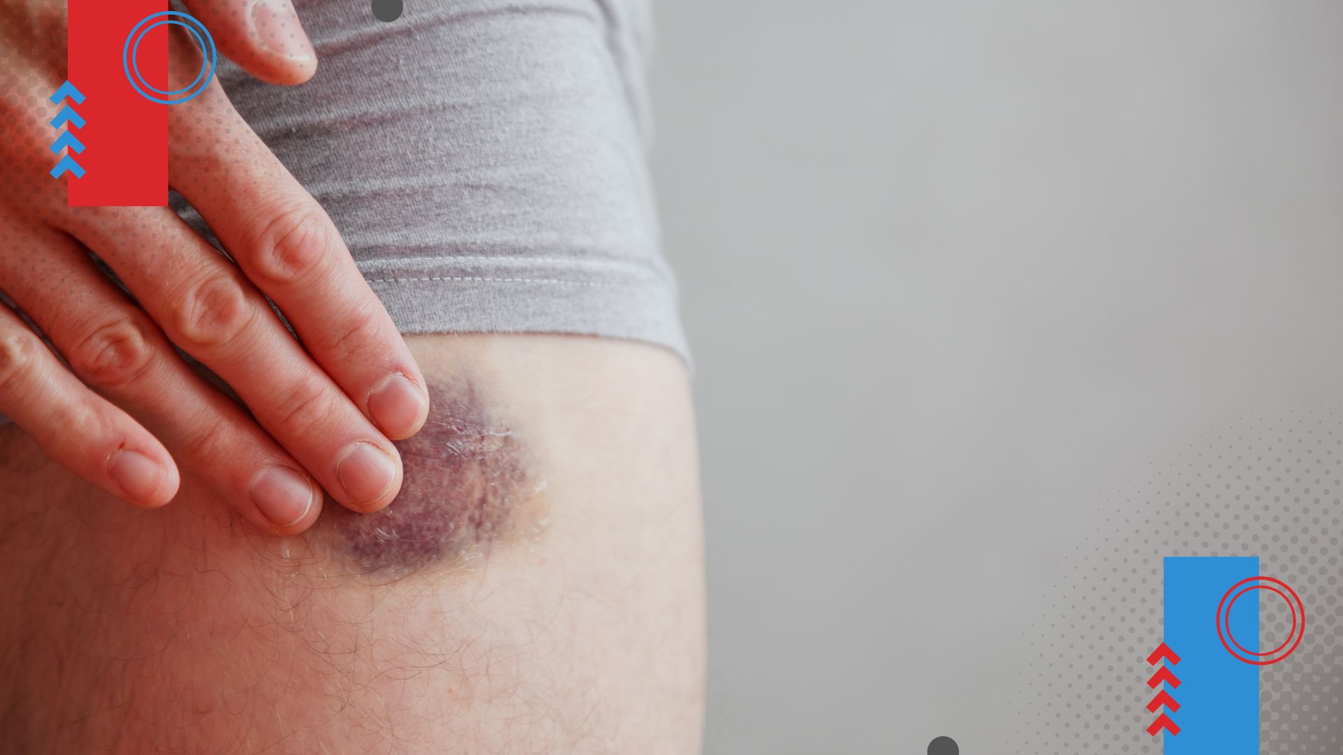 Hematomas frequentes não deveriam ser ignorados — nem dramatizados